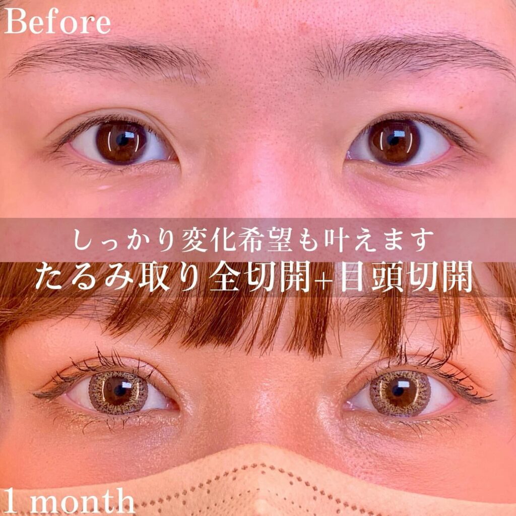 eclinic仙台院のたるみ取り併用全切開二重術+目頭切開