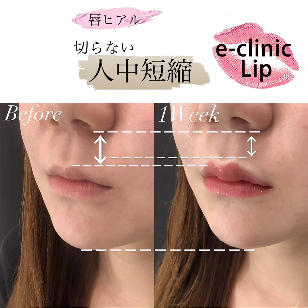 唇のヒアルロン酸で人中を短縮した症例写真