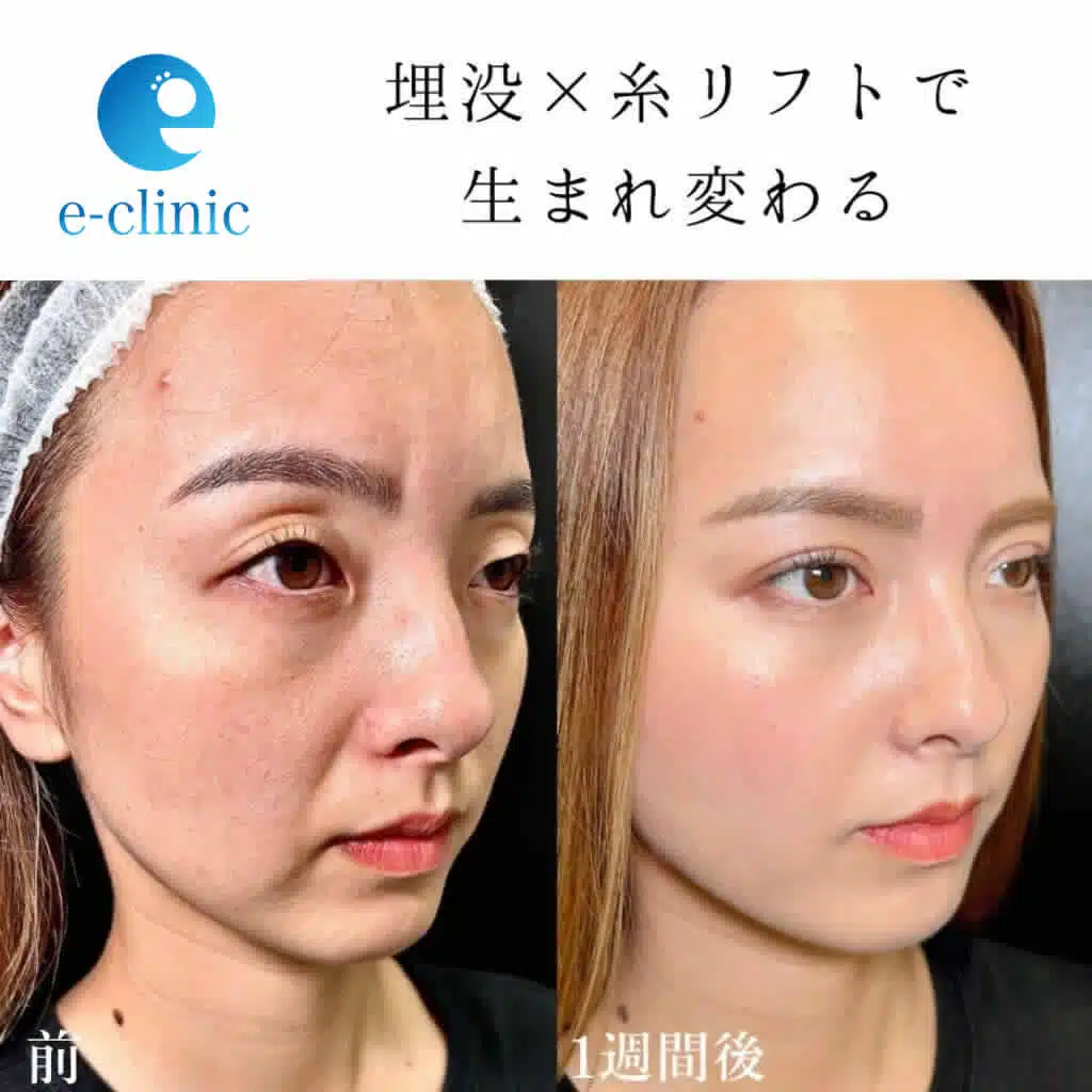 埋没　糸リフト