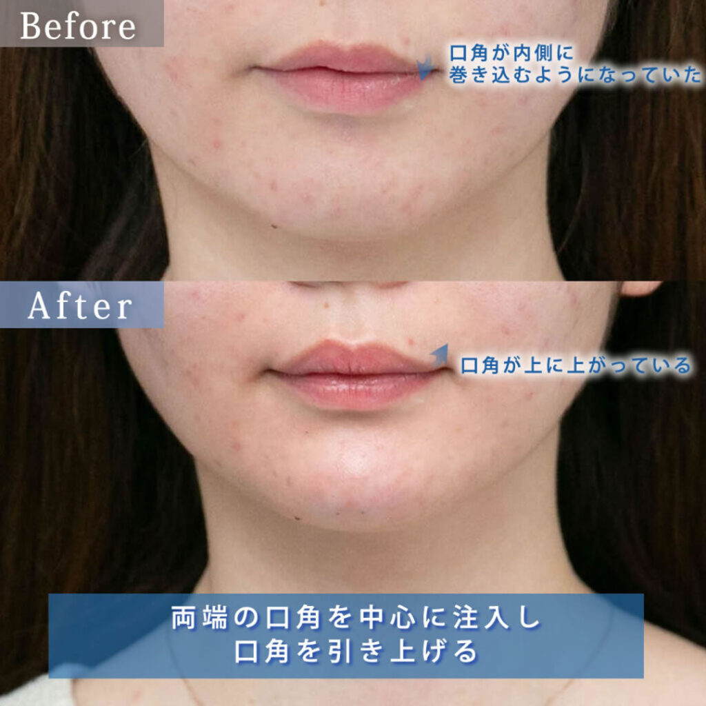 20代の口角を上げた唇のヒアルロン酸を正面からみた症例