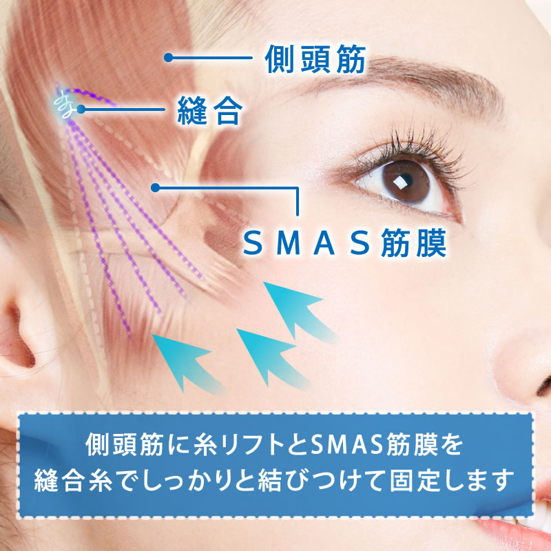 ハイブリッドリフトフェイスリフトの図解