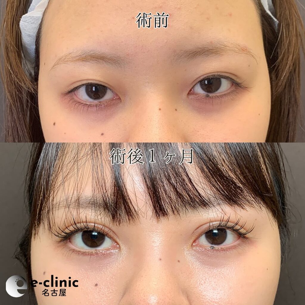 eclinic仙台院の全切開二重術