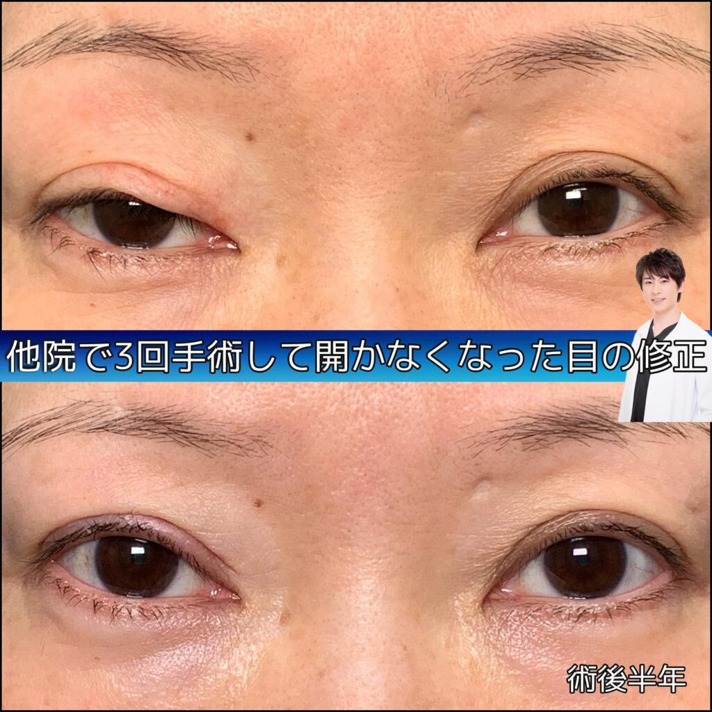 eclinic仙台院の全切開二重術他院修正