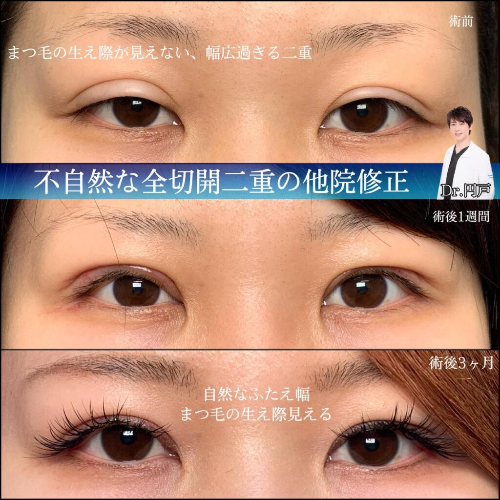 eclinic仙台院の全切開二重術の他院修正