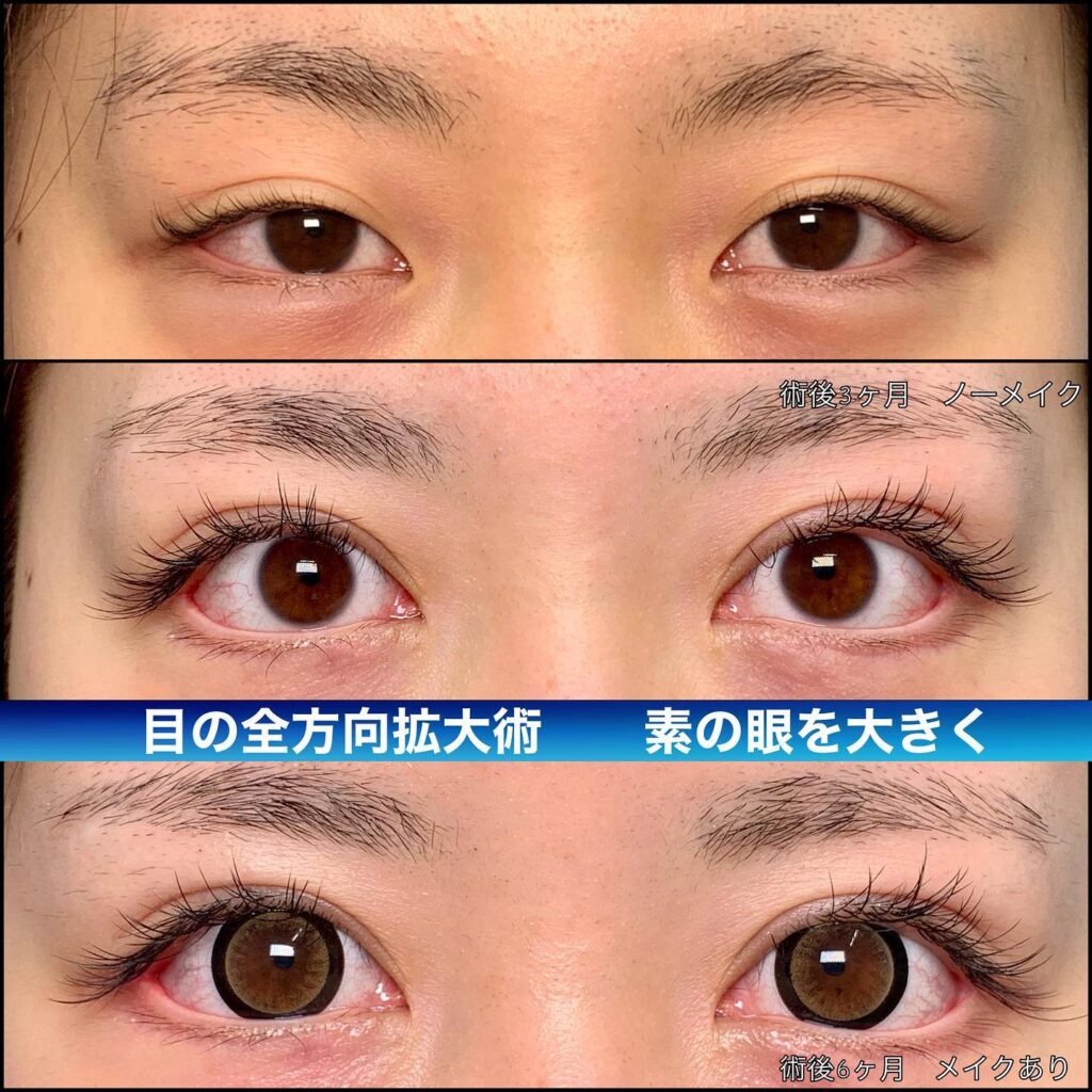 eclinic仙台院の全切開二重術