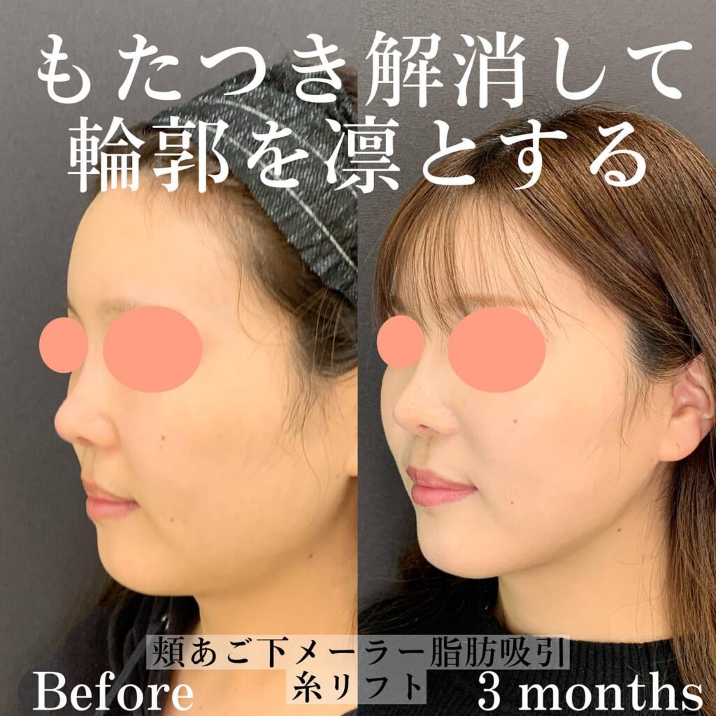 脂肪吸引　糸リフト