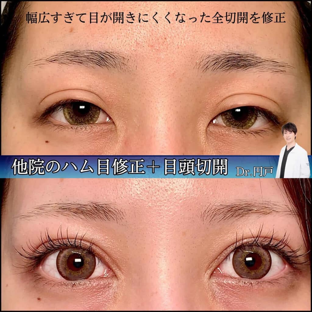 eclinic仙台院の全切開二重術の他院修正(ハム目修正)