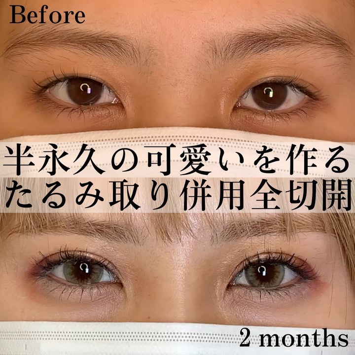 eclinic仙台院のたるみ取り併用全切開二重術