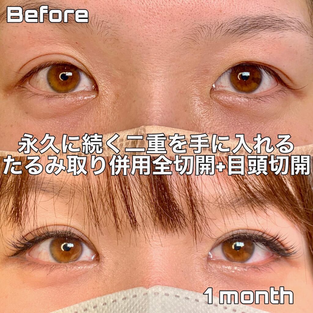 eclinic仙台院のたるみ取り併用全切開二重術+目頭切開