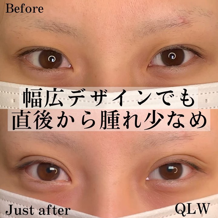 eclinic仙台院の二重埋没法(クイックダブルループ法)(裏留め4点)