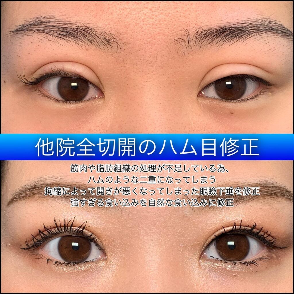 eclinic仙台院の全切開二重術の他院修正(ハム目修正)