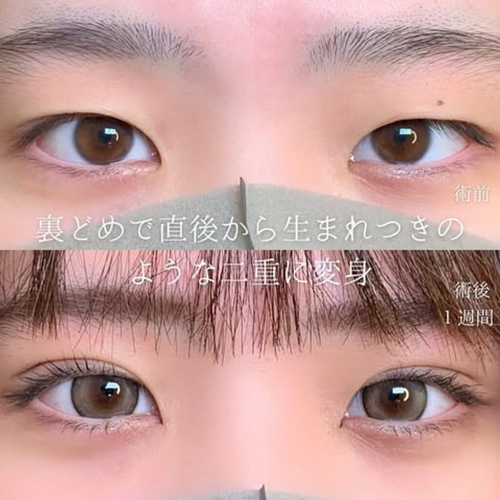 eclinic仙台院の二重埋没法