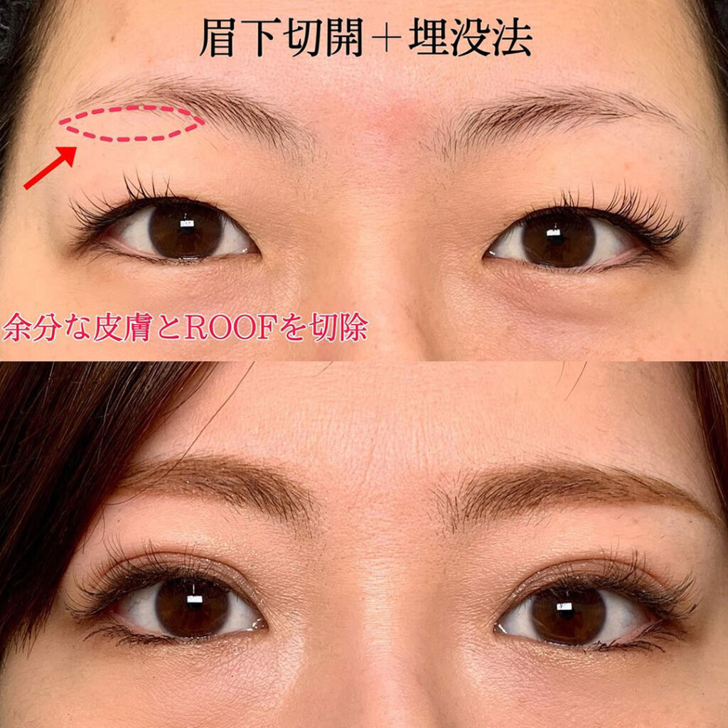eclinic仙台院の二重埋没法+眉下切開