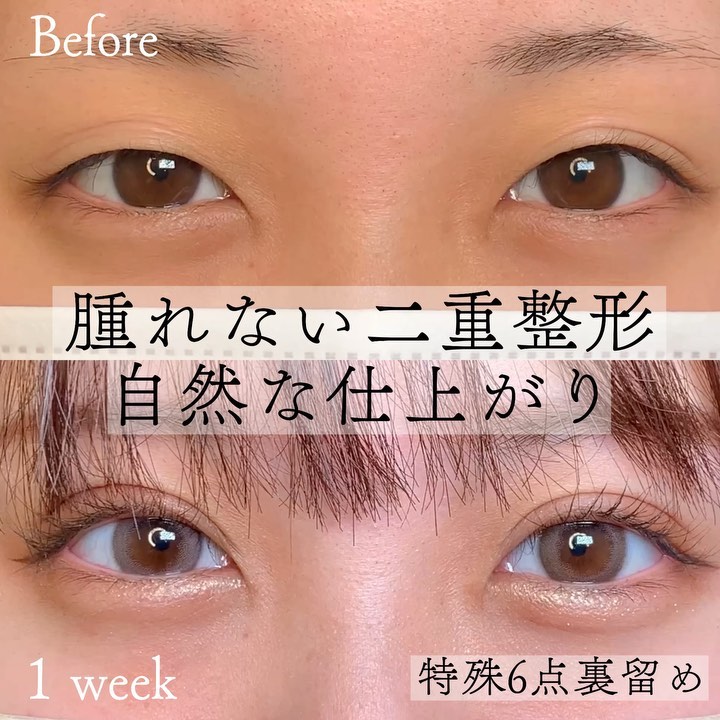 eclinic仙台院の二重埋没法(特殊6点裏留め)
