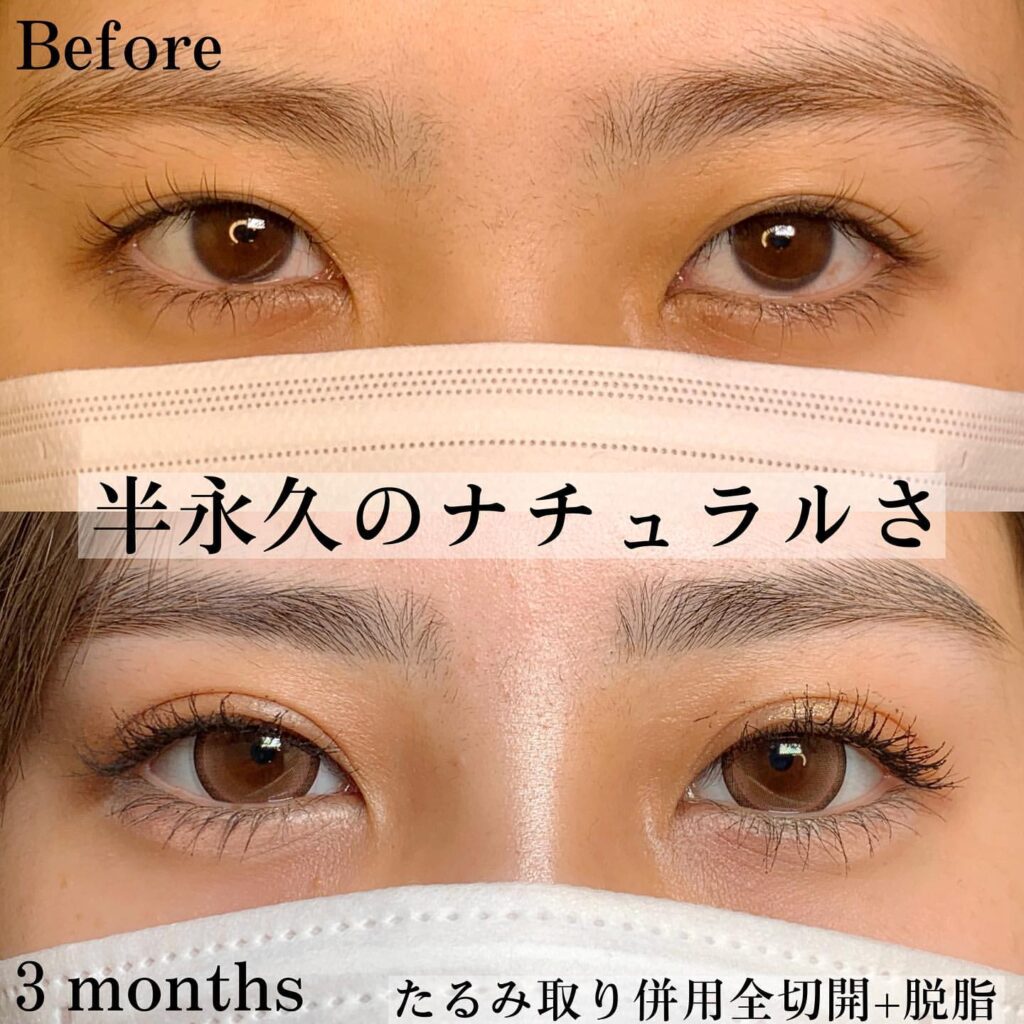 eclinic仙台院のたるみ取り併用全切開二重術+脱脂