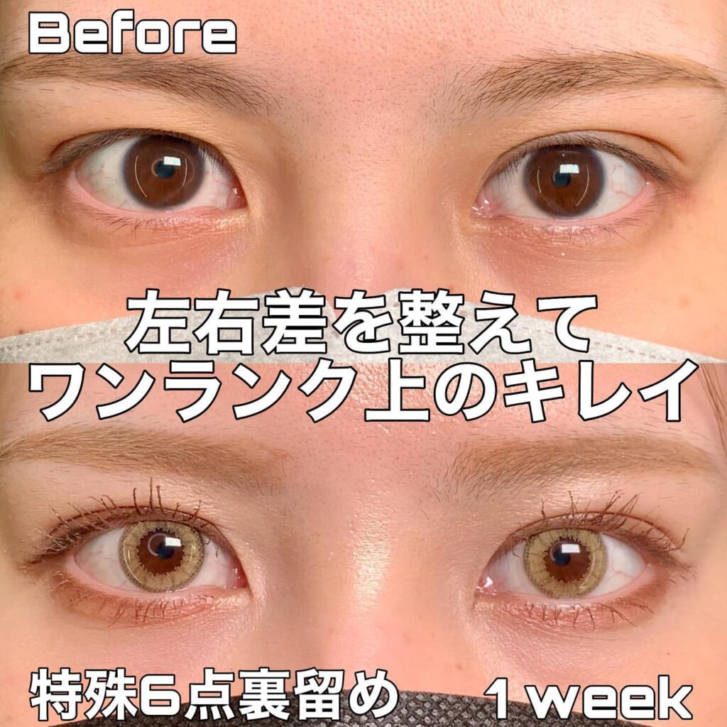 eclinic仙台院の二重埋没法(特殊6点裏留め)