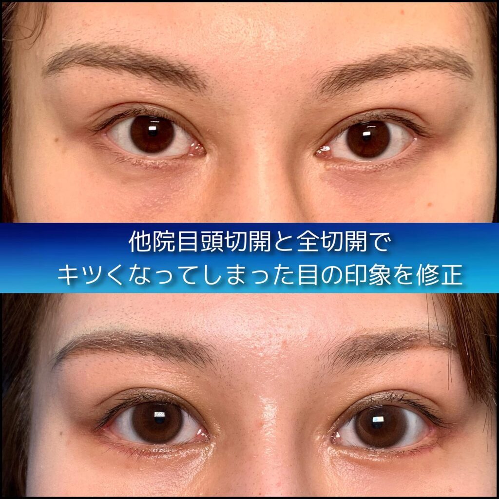 eclinic仙台院の全切開二重術の他院修正+眼瞼下垂
