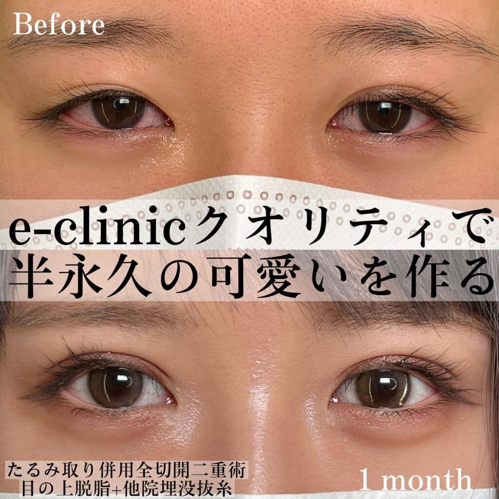 eclinic仙台院のたるみ取り併用全切開二重術+目の上脱脂+他院埋没抜糸