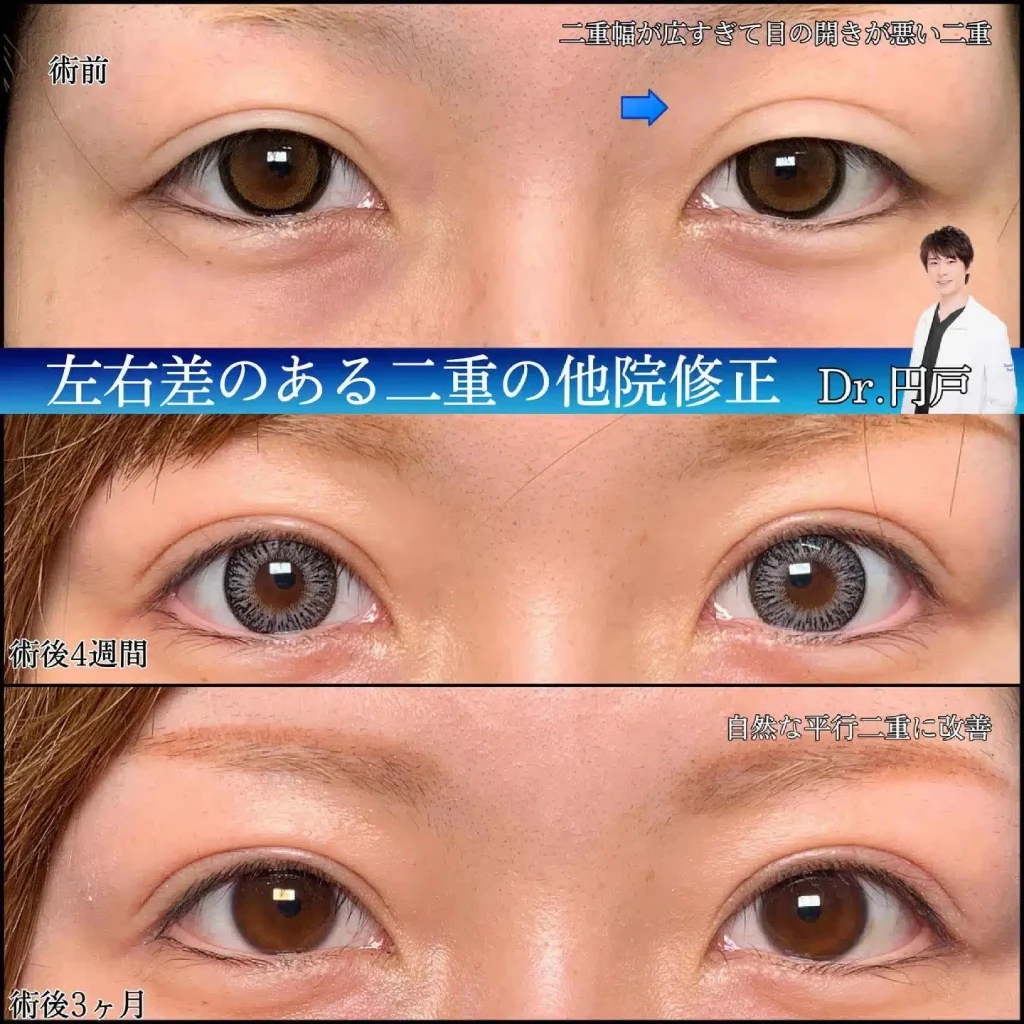 eclinic仙台院の全切開二重術の他院修正
