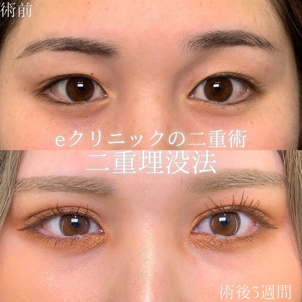 eclinic仙台院の二重埋没法