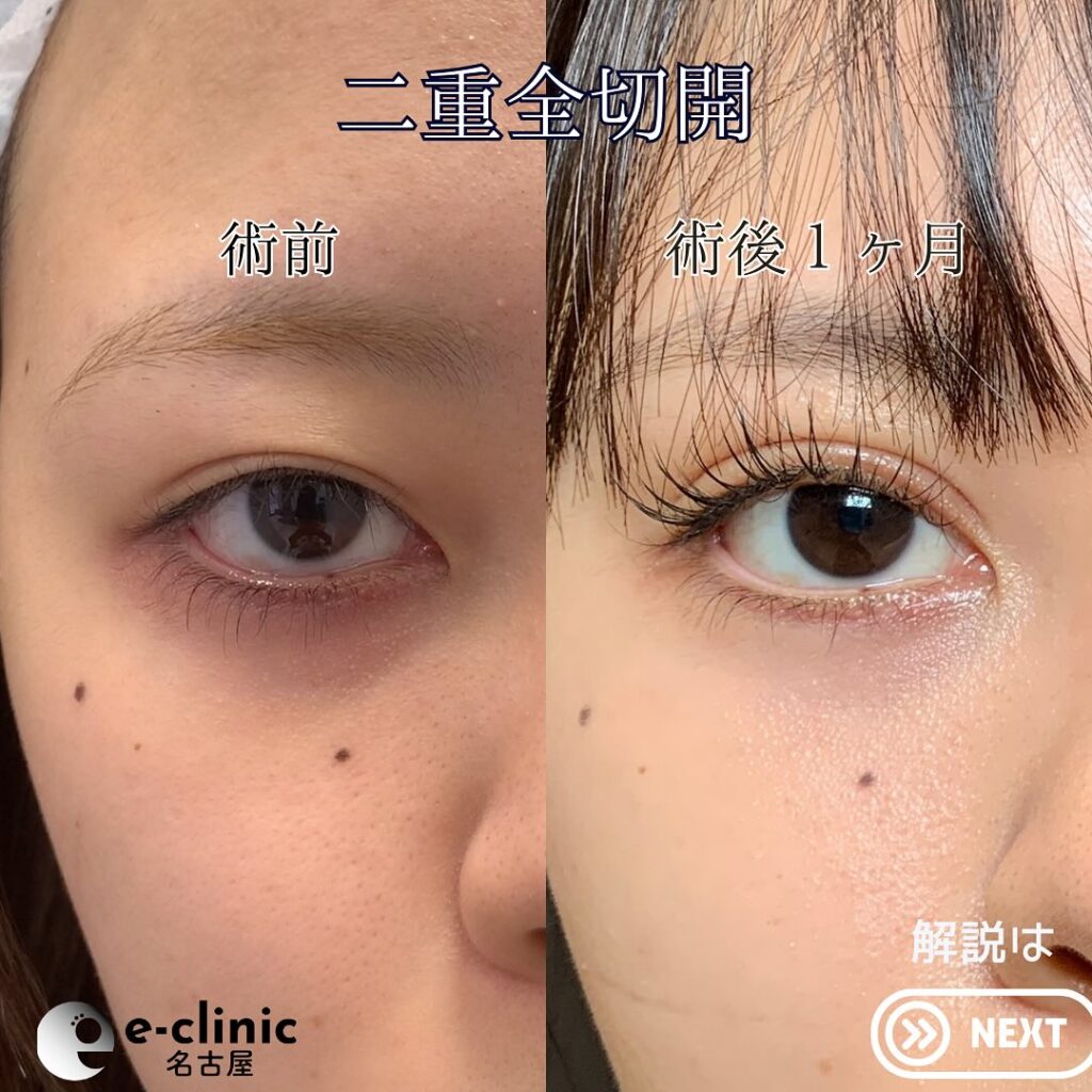 eclinic仙台院の全切開二重術