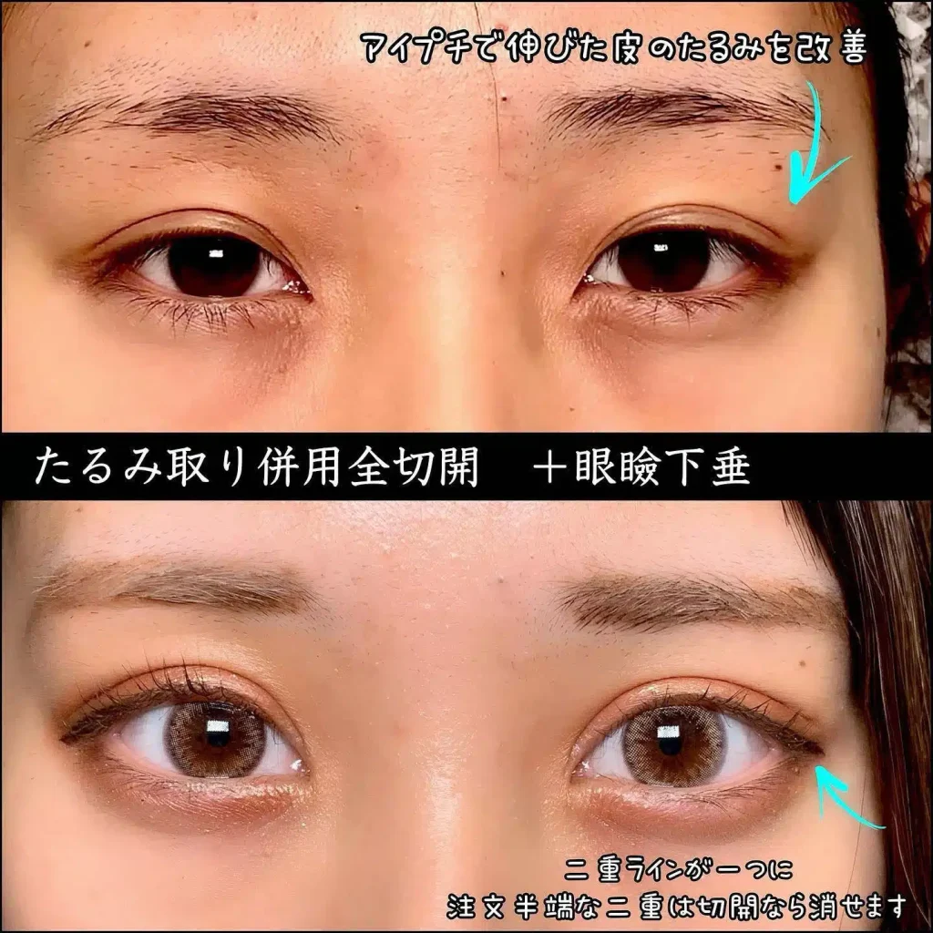 eclinic仙台院のたるみ取り併用全切開二重術+眼瞼下垂