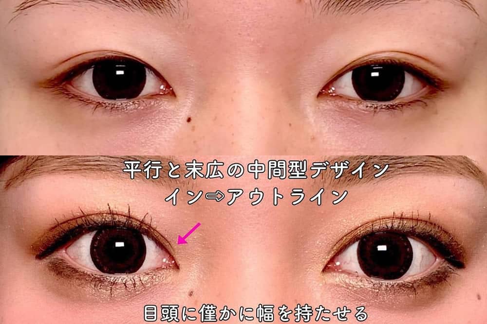 eclinic仙台院の二重埋没法
