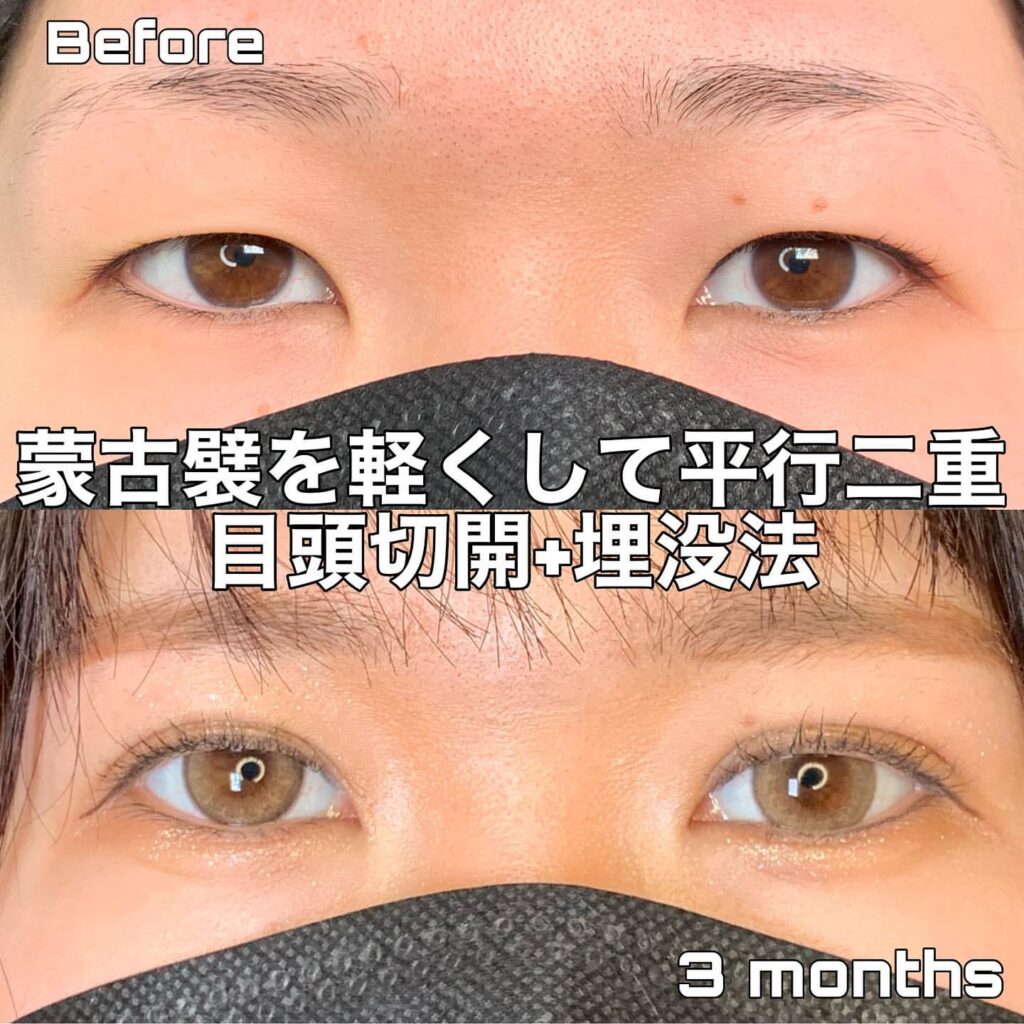 eclinic仙台院の二重埋没法+目頭切開