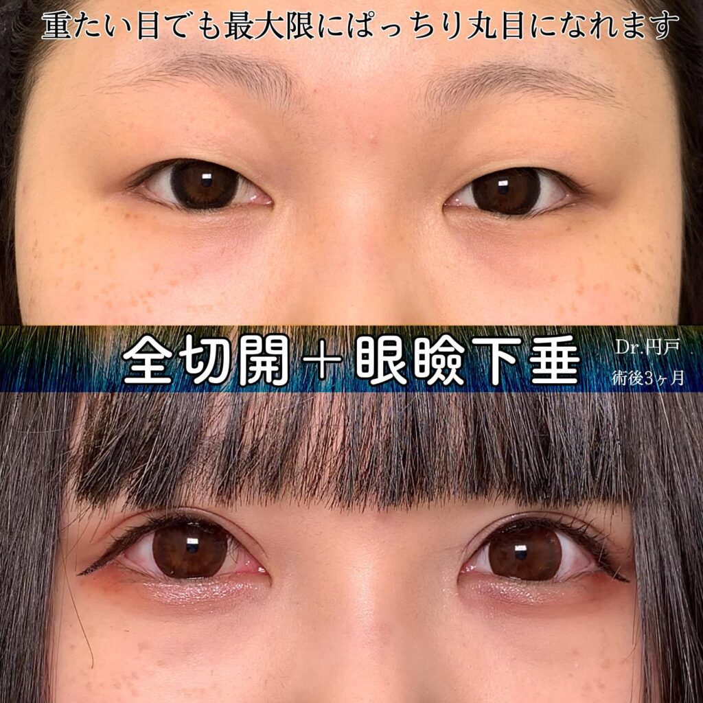 eclinic仙台院の二重埋没法