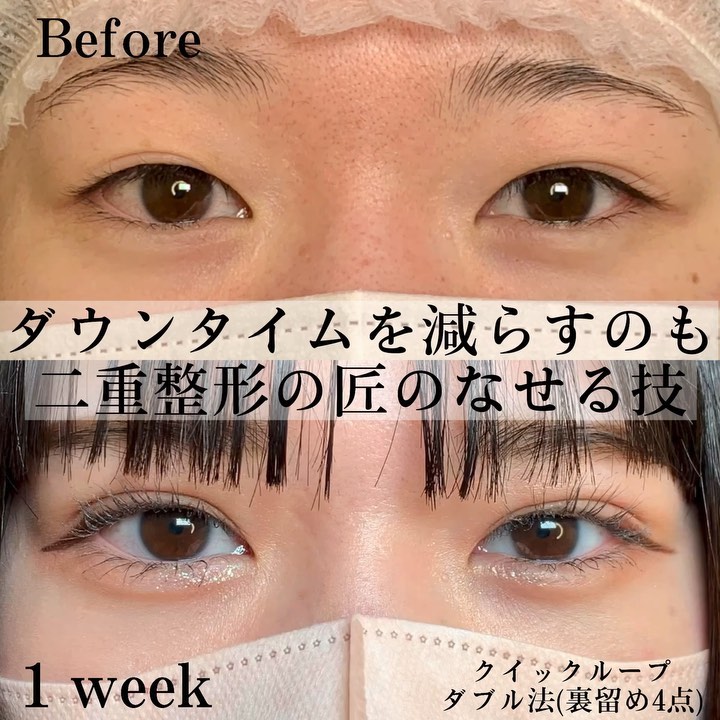 eclinic仙台院の二重埋没法(クイックダブルループ法)(裏留め4点)