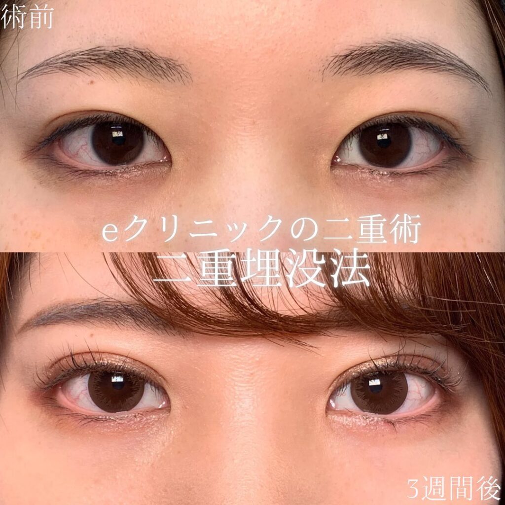 eclinic仙台院の二重埋没法