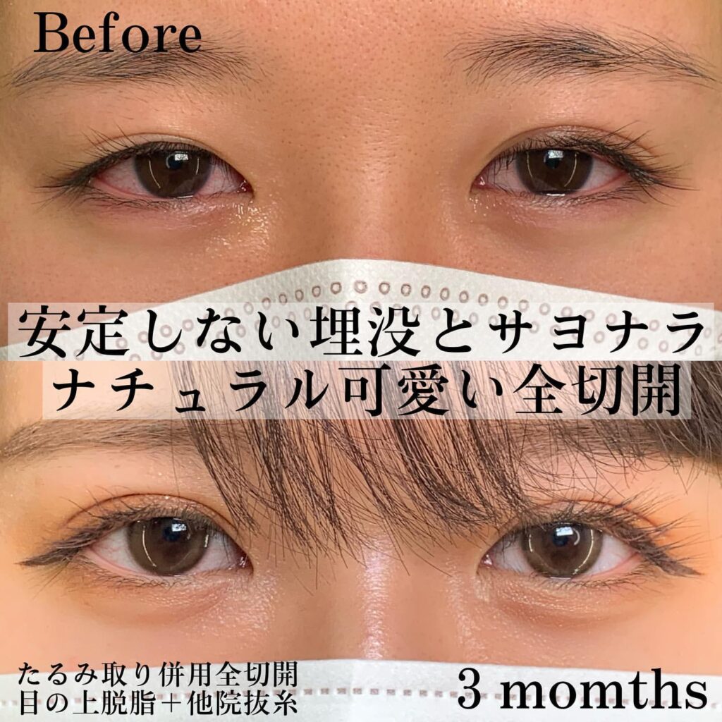 eclinic仙台院のたるみ取り併用全切開二重術の他院修正+目の上脱脂+他院埋没抜糸