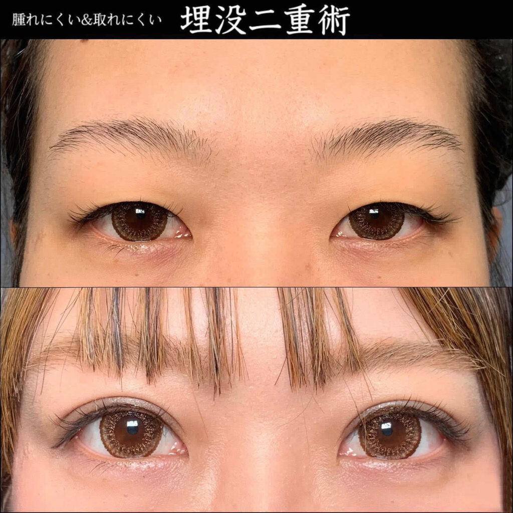eclinic仙台院の二重埋没法