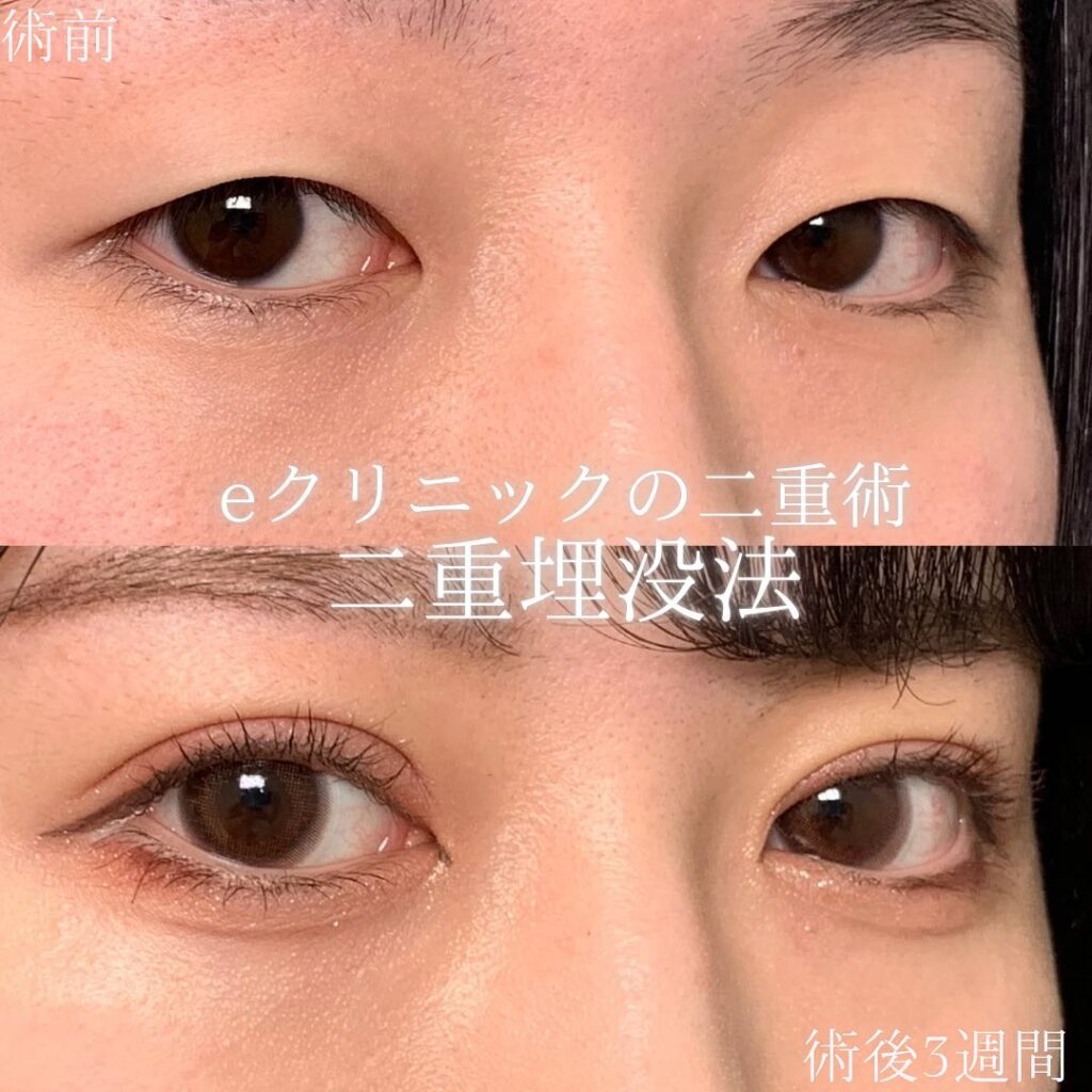 eclinic仙台院の二重埋没法