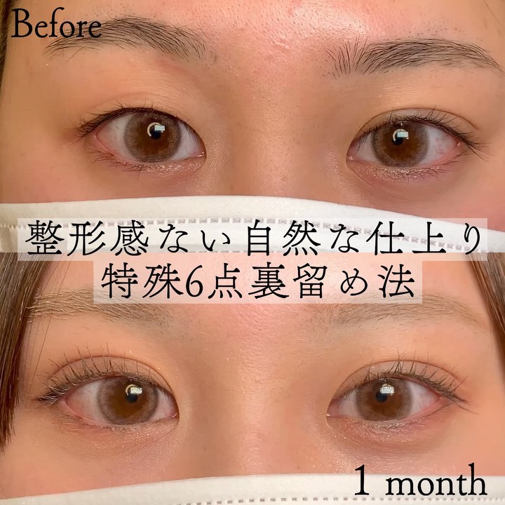 eclinic仙台院の二重埋没法(特殊6点裏留め法)