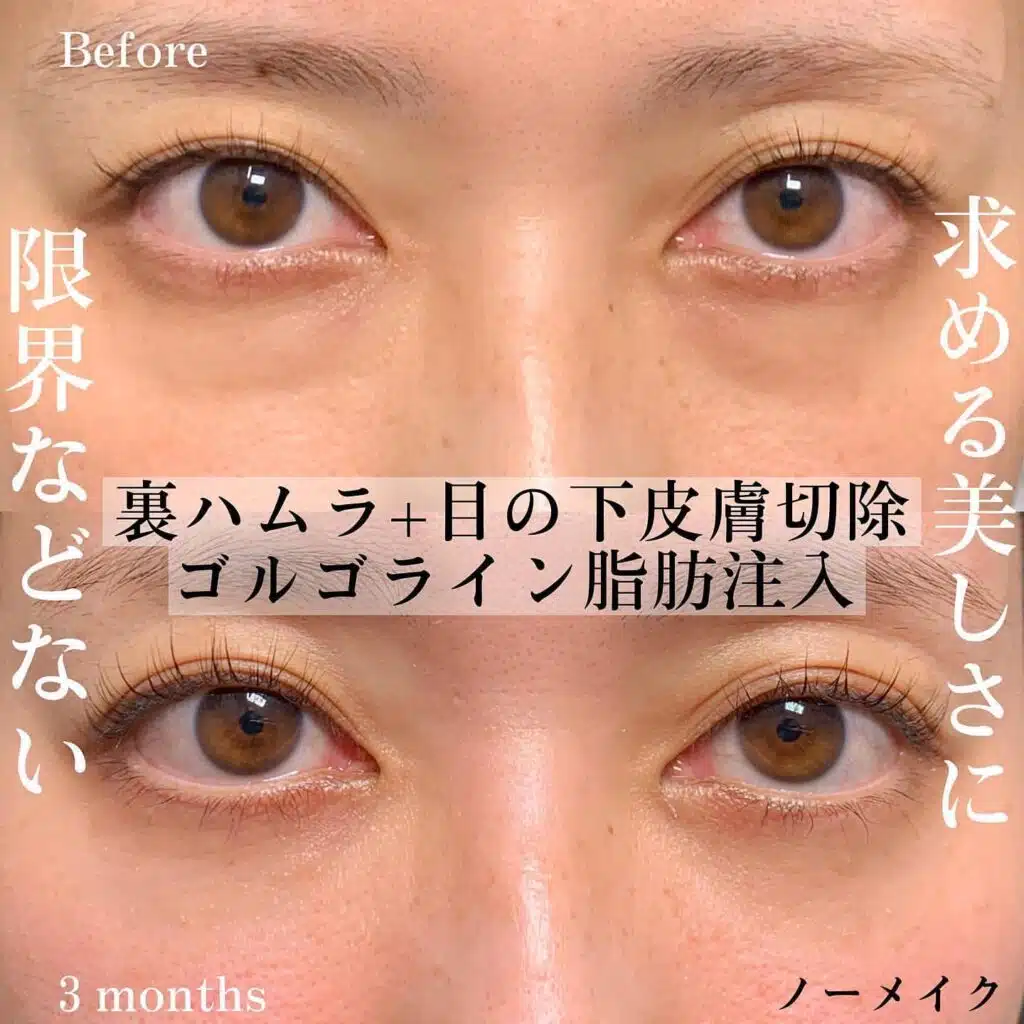 裏ハムラ　皮膚切除　脂肪注入