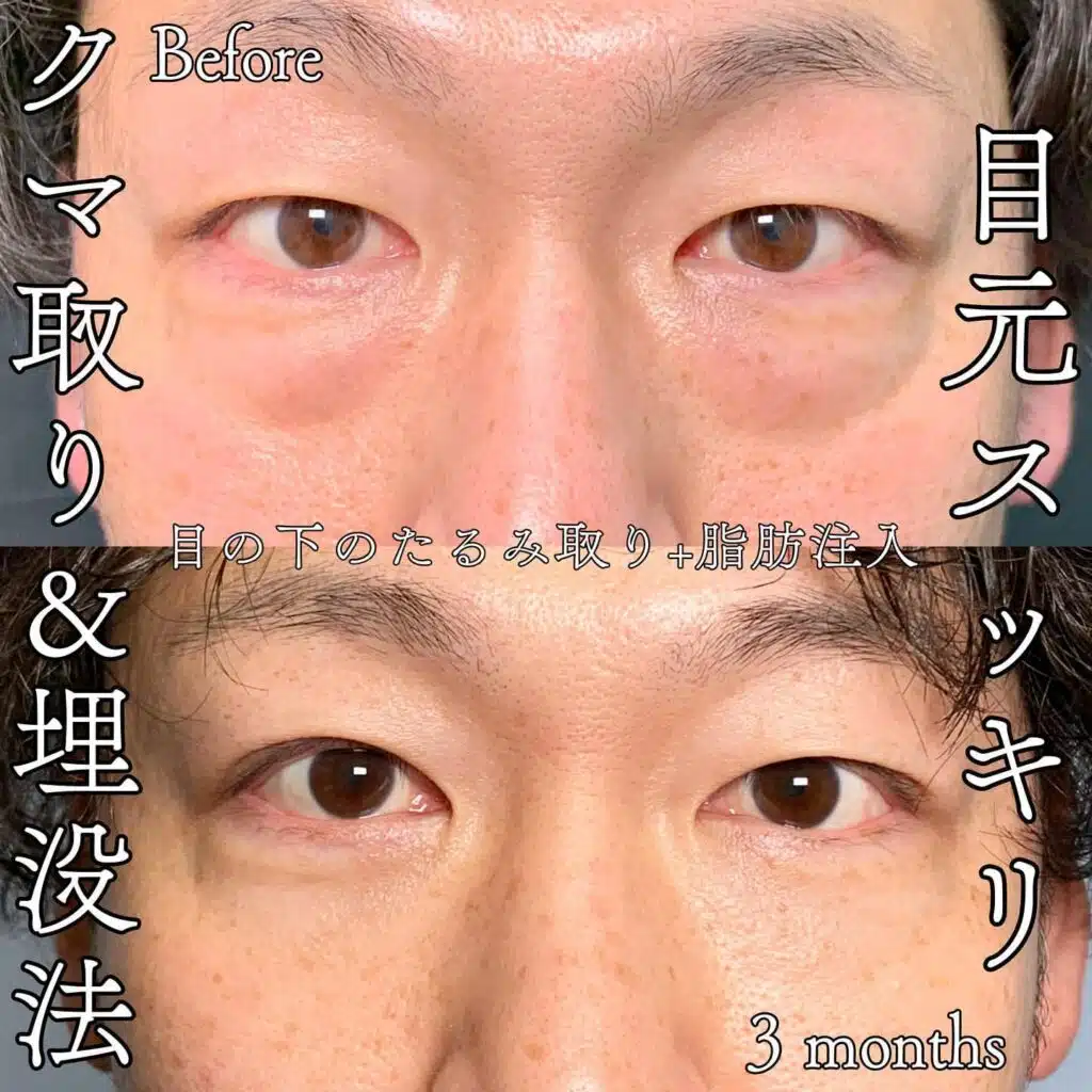 クマ取り　埋没