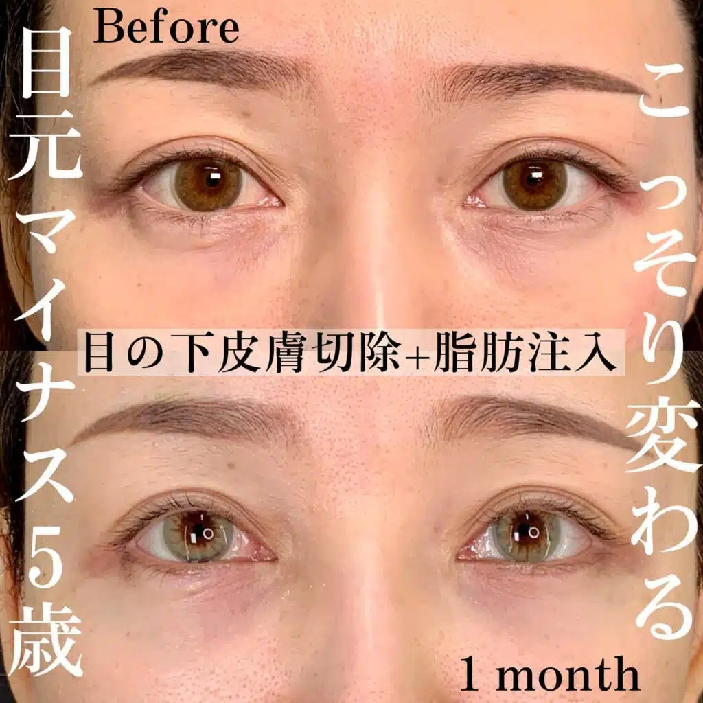 皮膚切除　脂肪注入