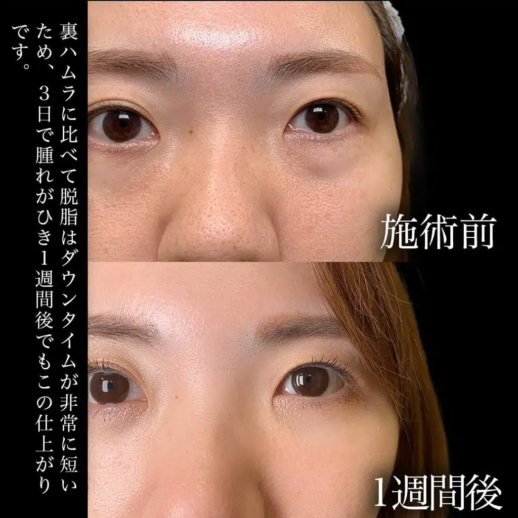 脱脂　ヒアルロン酸