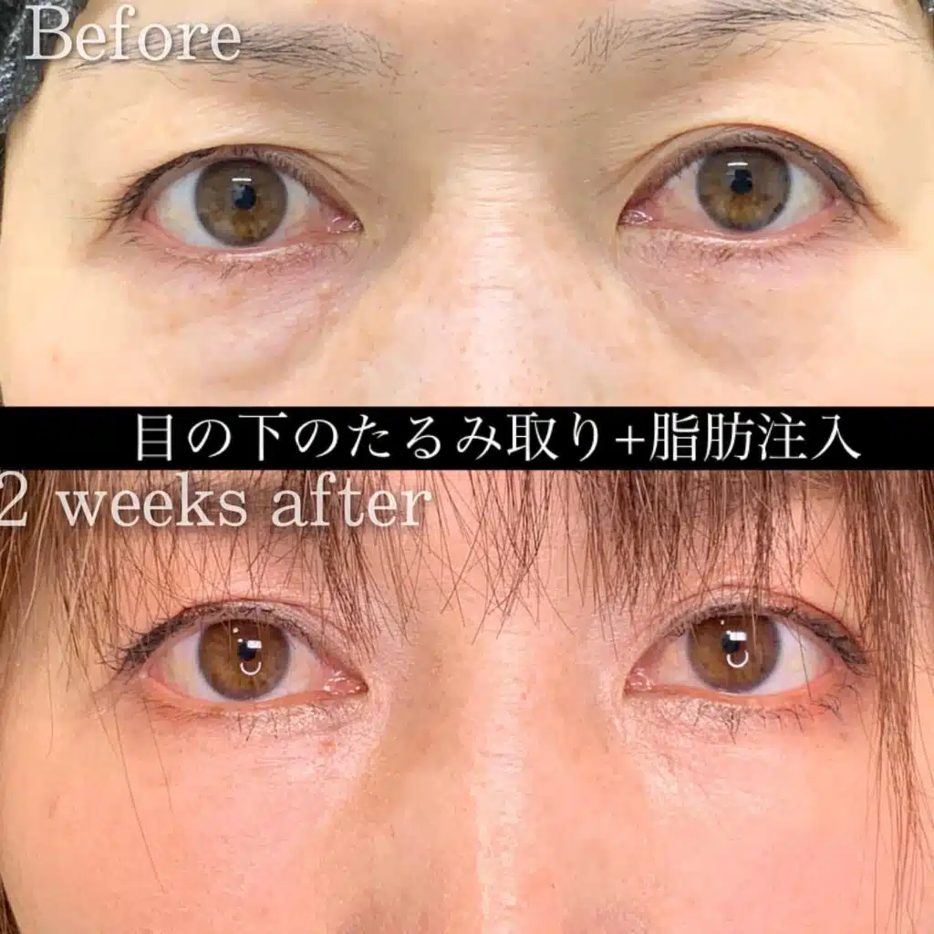 たるみ取り　脂肪注入