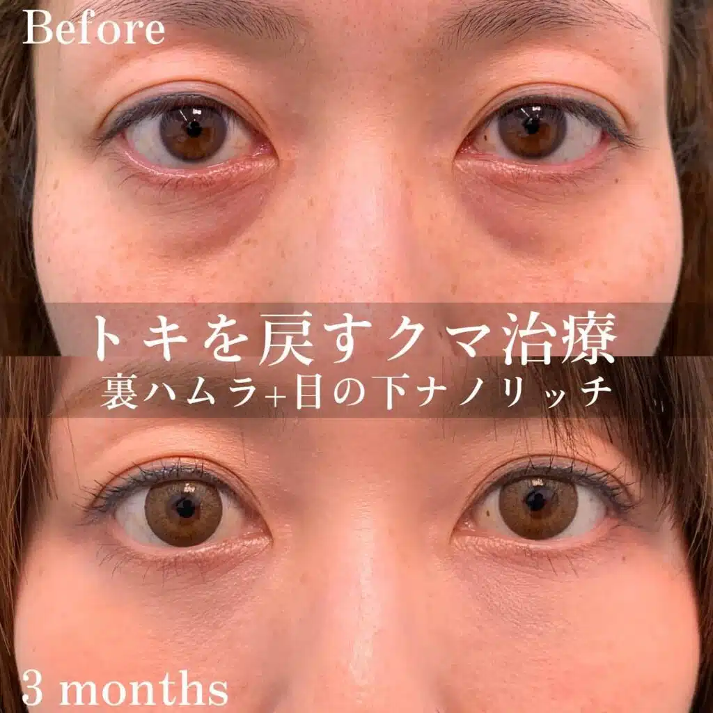 裏ハムラ　ナノリッチ
