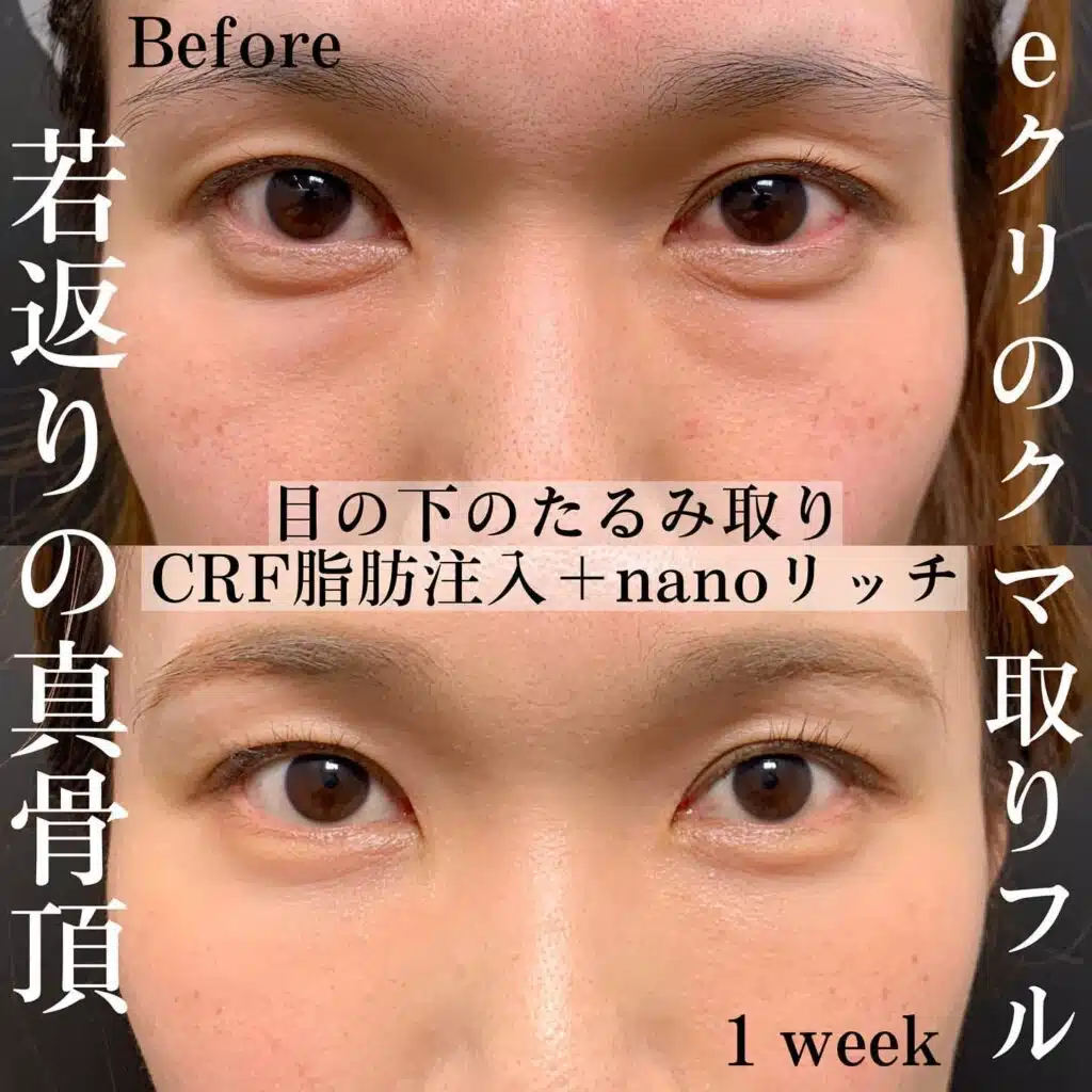 脂肪注入　ナノリッチ
