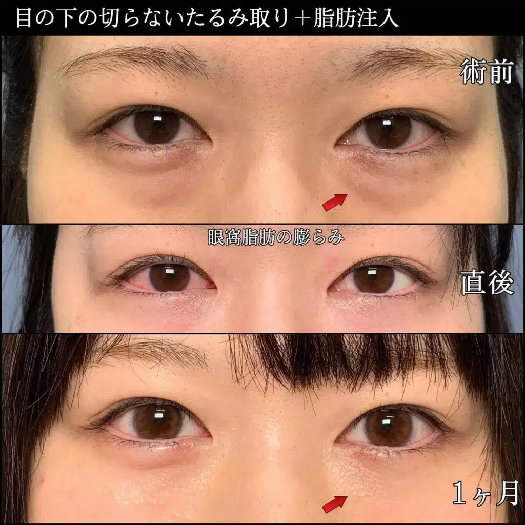たるみ取り　脂肪注入