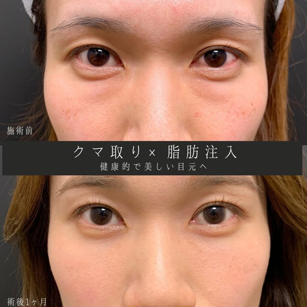eクリニック仙台院のクマ取りと脂肪注入の症例