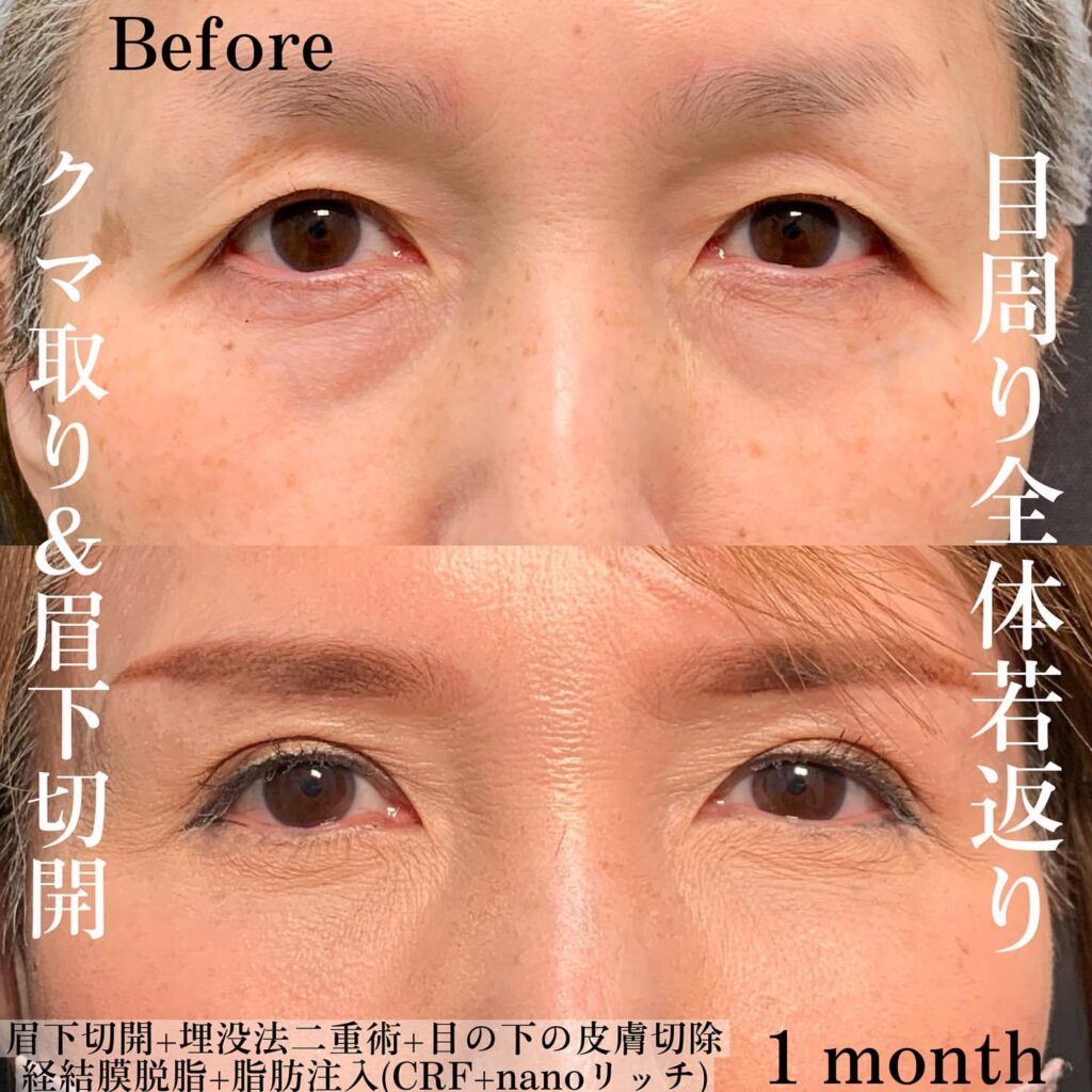 eクリニック仙台院の経血膜脱脂の症例写真(4)