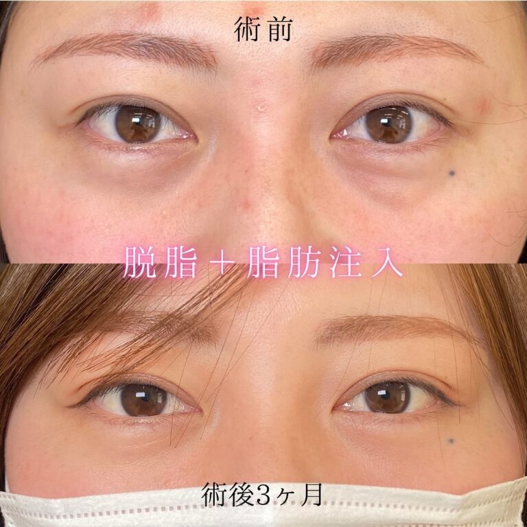 eクリニック仙台院の経血膜脱脂の症例写真(5)