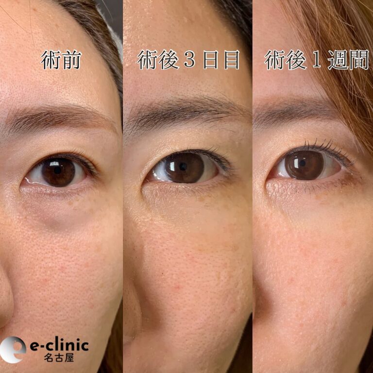 eクリニック仙台院の経血膜脱脂の症例写真(6)