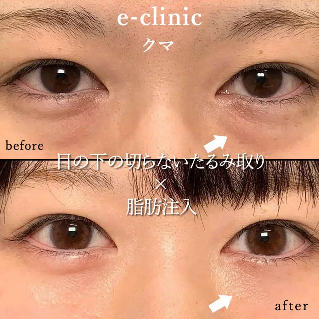 eクリニック仙台院の経血膜脱脂の症例写真(1)