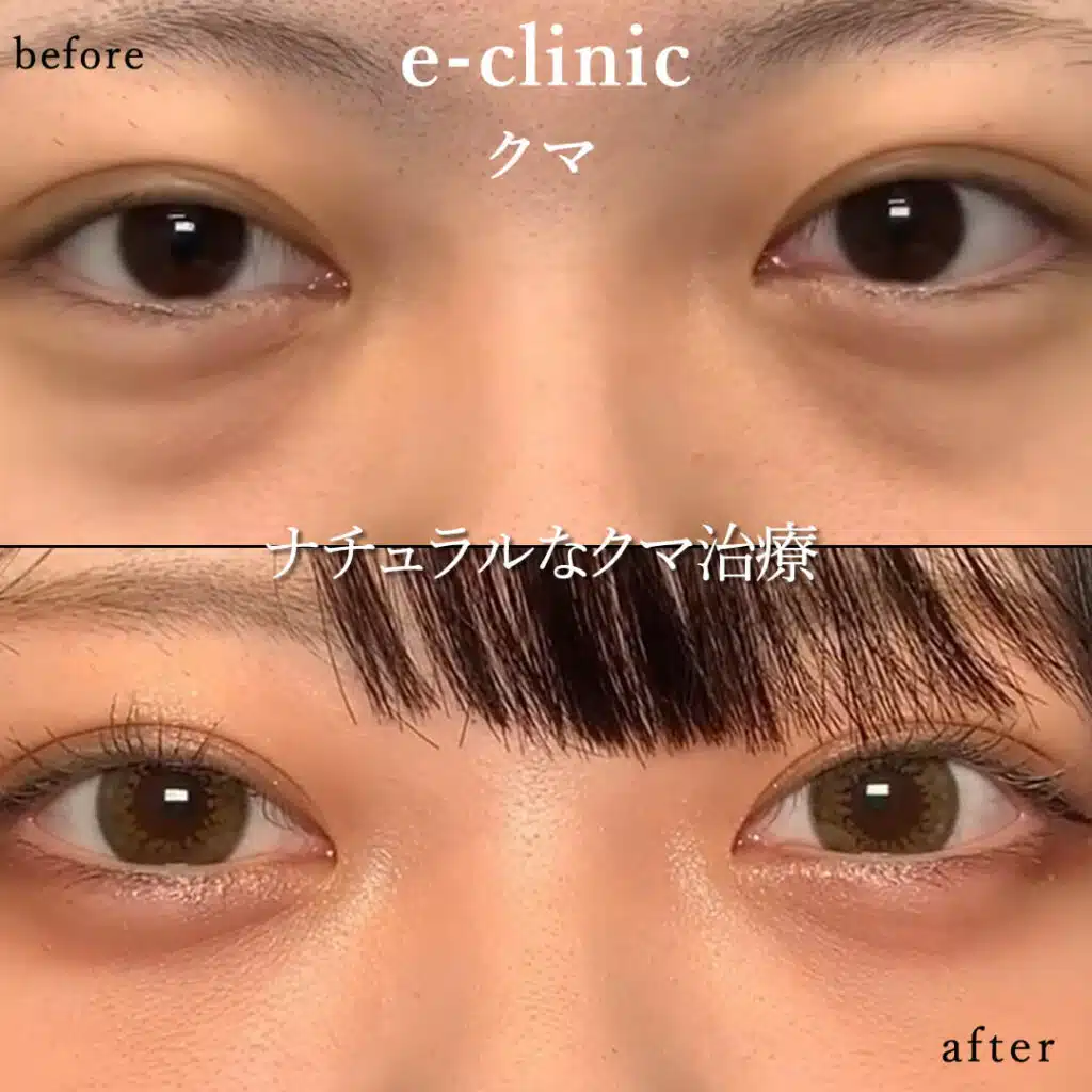 eクリニック仙台院の経血膜脱脂の症例写真(2)