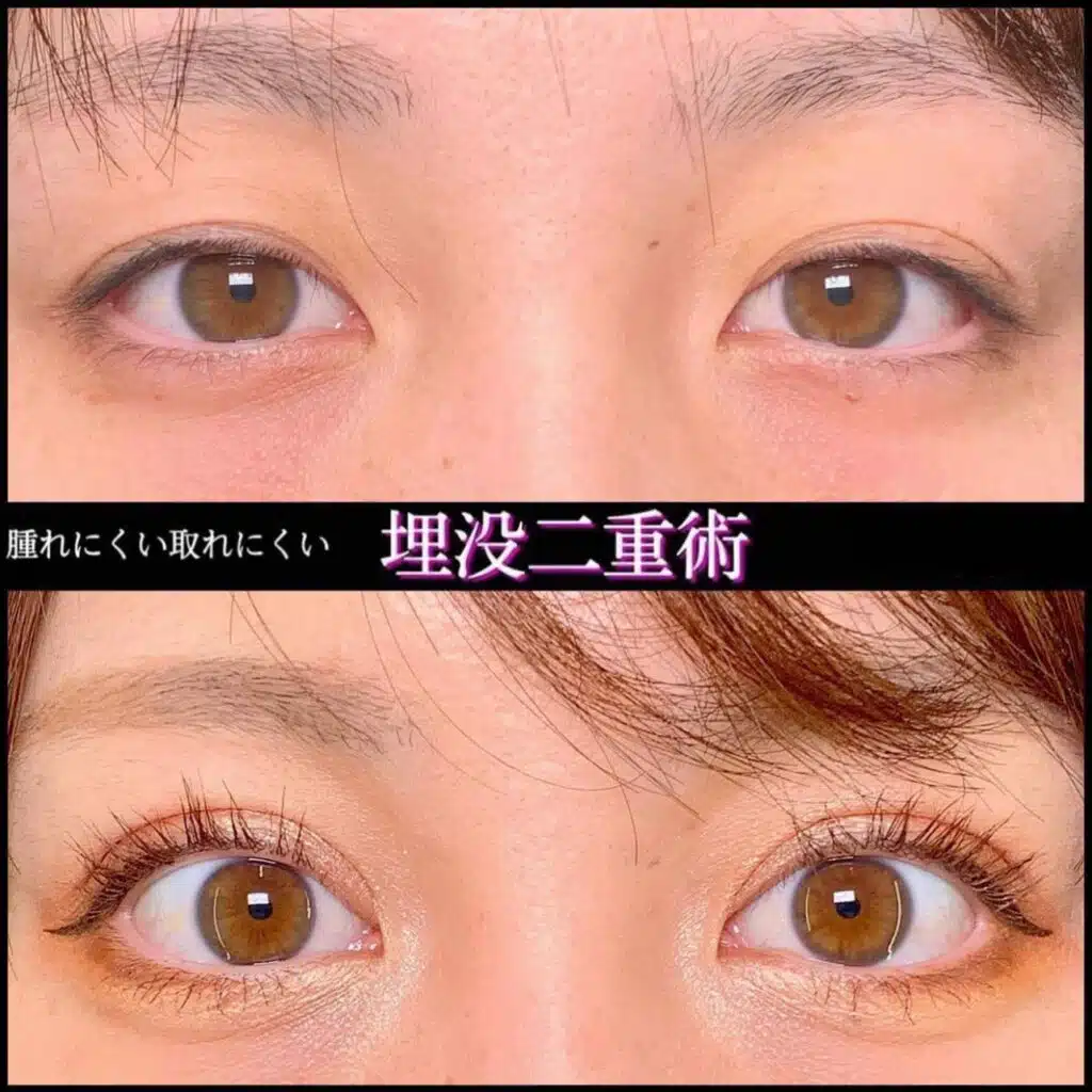 腫れにくい取れにくい 埋没二重術 仙台